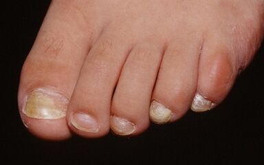 Causes of fungal appearance on the thumb of the foot