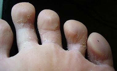 How the fungus looks on the legs and how to treat