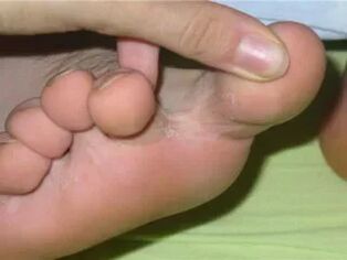 Itching toes