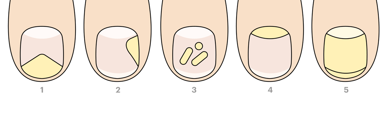 types of nail fungus