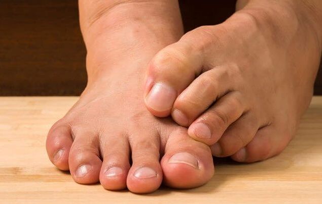 athlete's foot and remedies