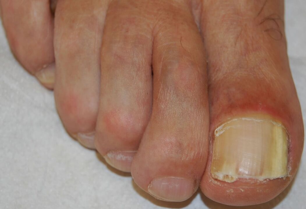 Distal-lateral subungual onychomycosis on the foot